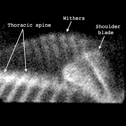 Kissing Spine Symptoms - Nuclear Scan